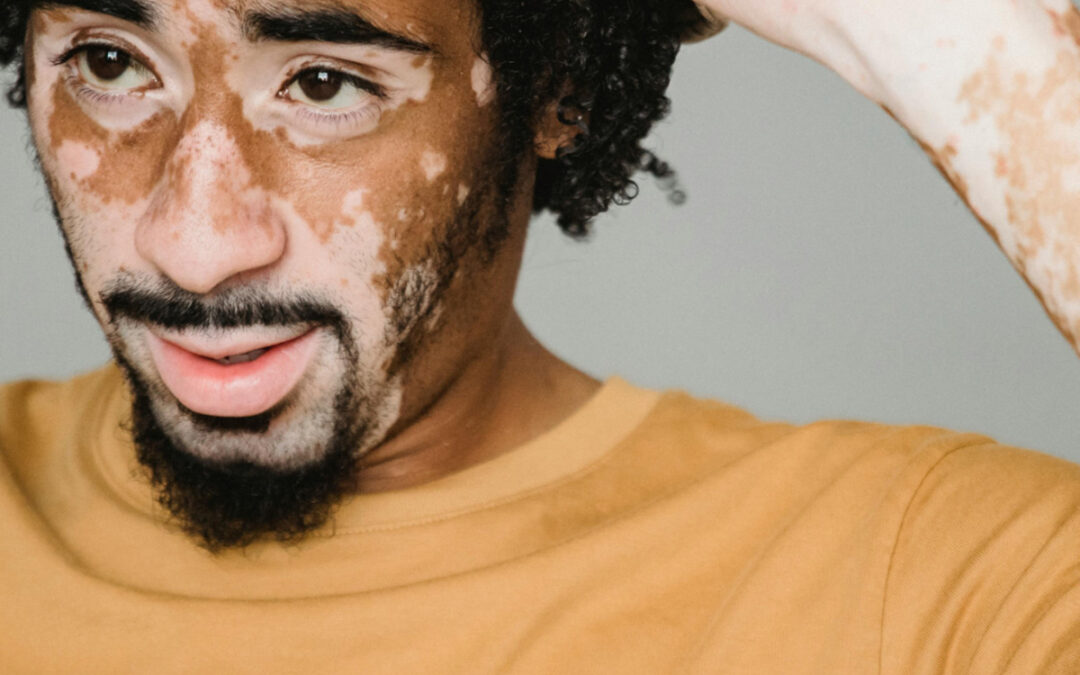 March is National Autoimmune Disease Awareness Month